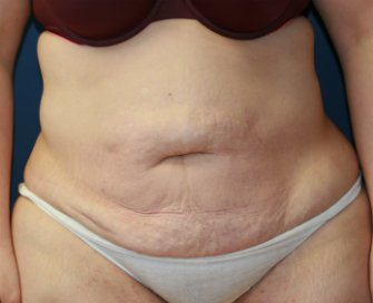 Tummy tuck san diego 76 - before - front