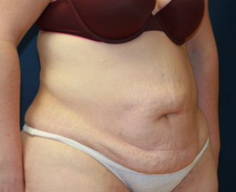 Tummy tuck san diego 76 - before - oblique
