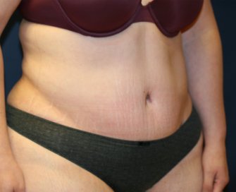 Tummy tuck san diego 76 - after - oblique