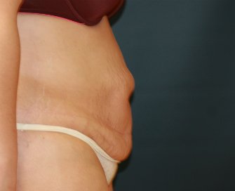 Tummy tuck san diego 76 - before - side