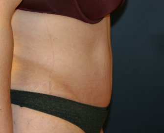 Tummy tuck san diego 76 - after - side