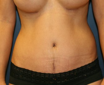Tummy tuck san diego 77 - after - front