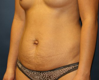 Tummy tuck san diego 77 - before - oblique