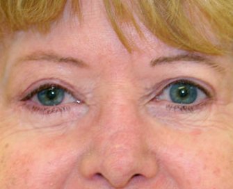 Blepharoplasty Case 13 - after - front
