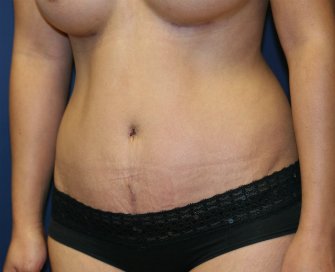 Tummy tuck san diego 77 - after - oblique