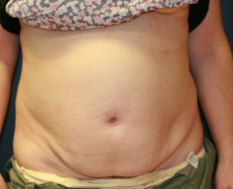Tummy tuck san diego 79 - before - front