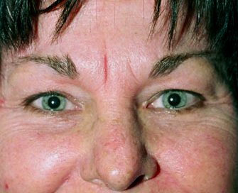 Blepharoplasty Case 14 - before - front