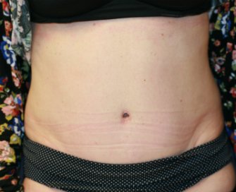 Tummy tuck san diego 79 - after - front