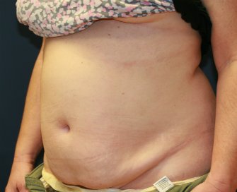 Tummy tuck san diego 79 - before - oblique