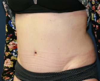 Tummy tuck san diego 79 - after - oblique