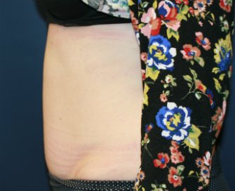 Tummy tuck san diego 79 - after - side
