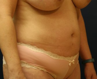 Tummy tuck san diego 80 - before - oblique