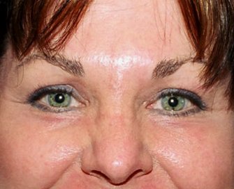 Blepharoplasty Case 14 - after - front