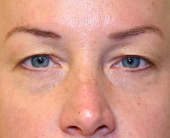 Blepharoplasty Case 15 - before - front