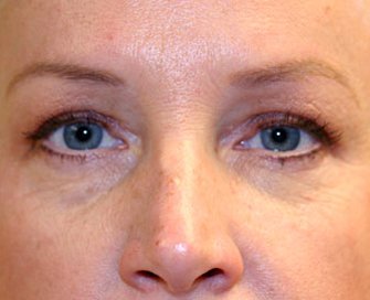 Blepharoplasty Case 15 - after - front