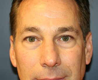 Bags-under-eyes-san-diego - before - front