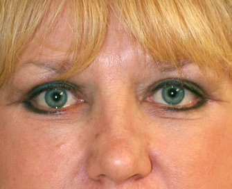 Blepharoplasty Case 16 - after - front