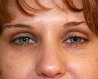 Blepharoplasty Case 17 - before - front