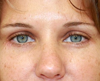 Blepharoplasty Case 17 - after - front