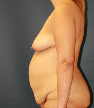 Breast Lift, Implants, Tummy Tuck - before - side