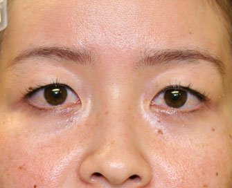 Blepharoplasty Case 18 - before - front