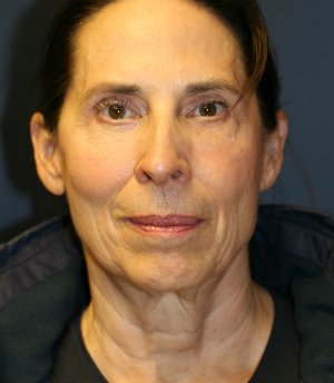 Neck and Lower Face Rejuvenation - before - side