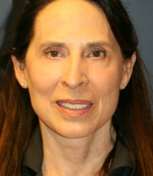 Neck and Lower Face Rejuvenation - after - side