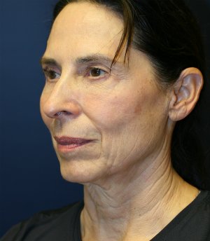 Neck and Lower Face Rejuvenation - before - oblique