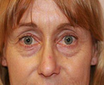 Blepharoplasty Case 19 - before - front