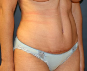 Tummy Tuck San Diego 81 - after - oblique