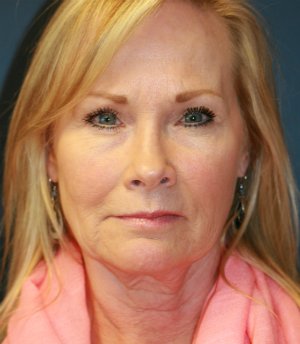Lower face and neck lift - before - front