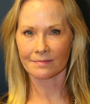 Lower face and neck lift - after - front