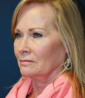 Lower face and neck lift - before - oblique