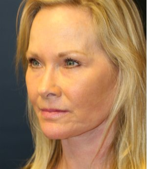 Lower face and neck lift - after - oblique