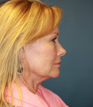 Lower face and neck lift - before - side