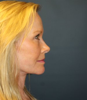Lower face and neck lift - after - side