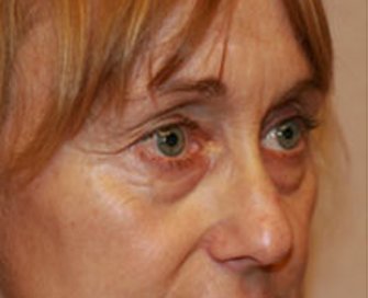 Blepharoplasty Case 19 - before - angle