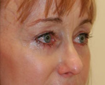 Blepharoplasty Case 19 - after - angle