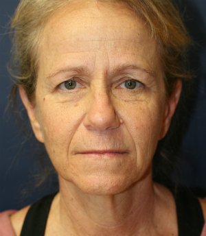 eyelid rejuvenation san diego - before - front