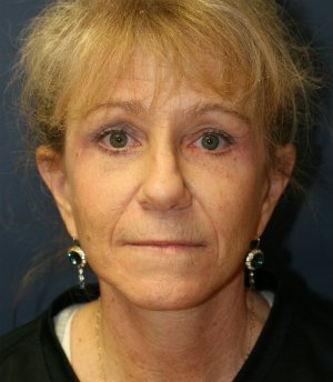 eyelid rejuvenation san diego - after - front