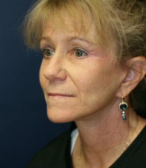 eyelid rejuvenation san diego - after - oblique