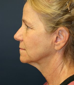 eyelid rejuvenation san diego - before - side