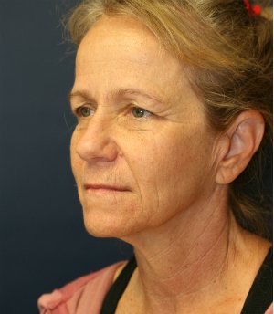 NeckLift Neck Lift San Diego - before - oblique