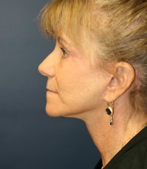 NeckLift Neck Lift San Diego - after - front