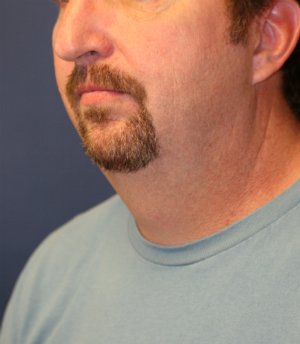 NeckLift & Chin Implant San Diego - before - oblique