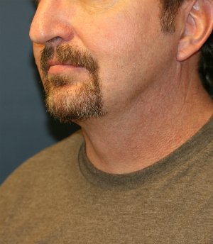 NeckLift & Chin Implant San Diego - after - oblique