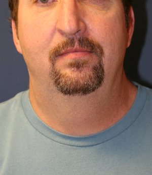 NeckLift & Chin Implant San Diego - before - side