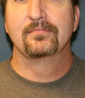 NeckLift & Chin Implant San Diego - after - side