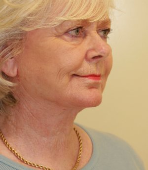 Neck and Lower Face Re-shaping - after - oblique