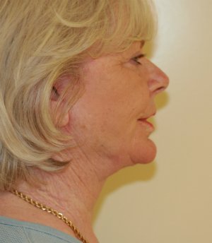Neck and Lower Face Re-shaping - after - front